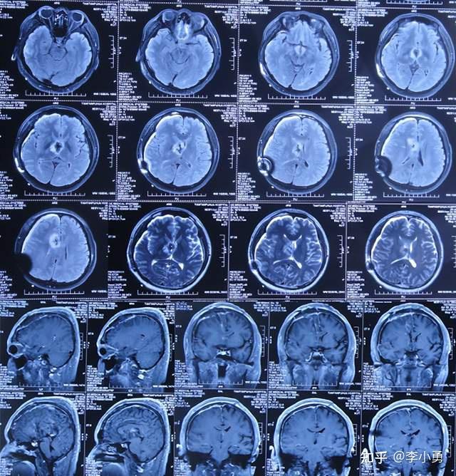 百洋医药脑肿瘤精准放疗中心签约落地